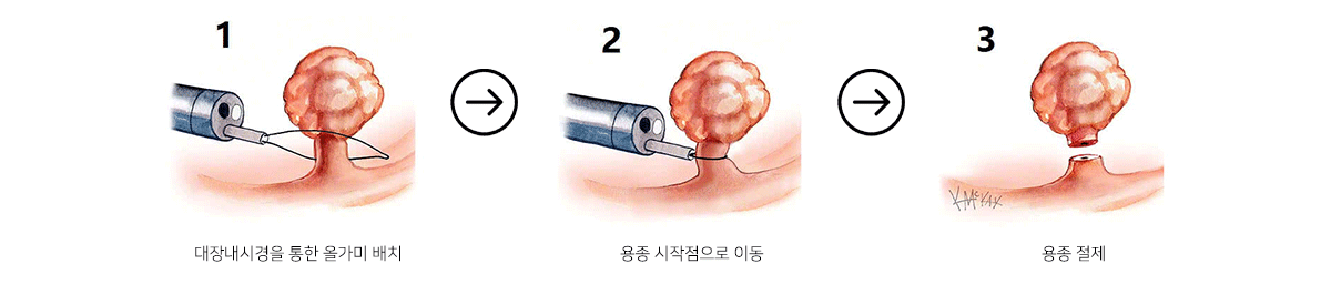 연세우리내과 용종절제 안내